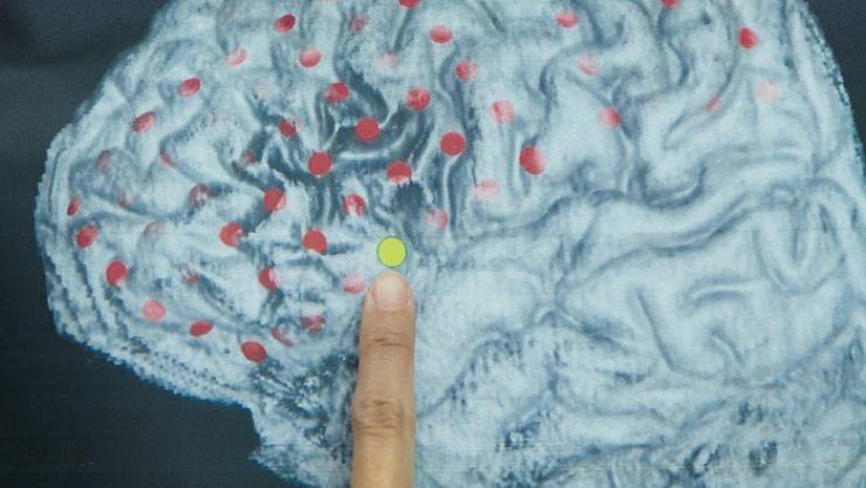'Covid-19 geçirenlerin beyninde küçülme tespit edildi'
