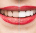 Diş beyazlatma (Bleaching) nedir?