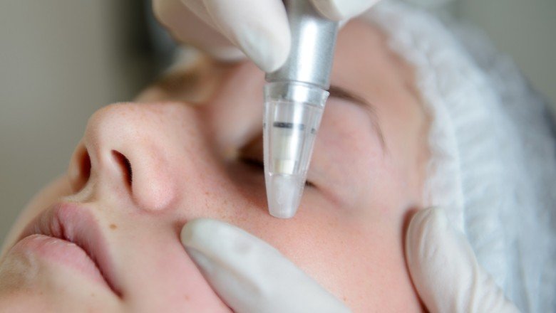 Dermapen ile Cilt Gençleştirme (Dermaterapi)